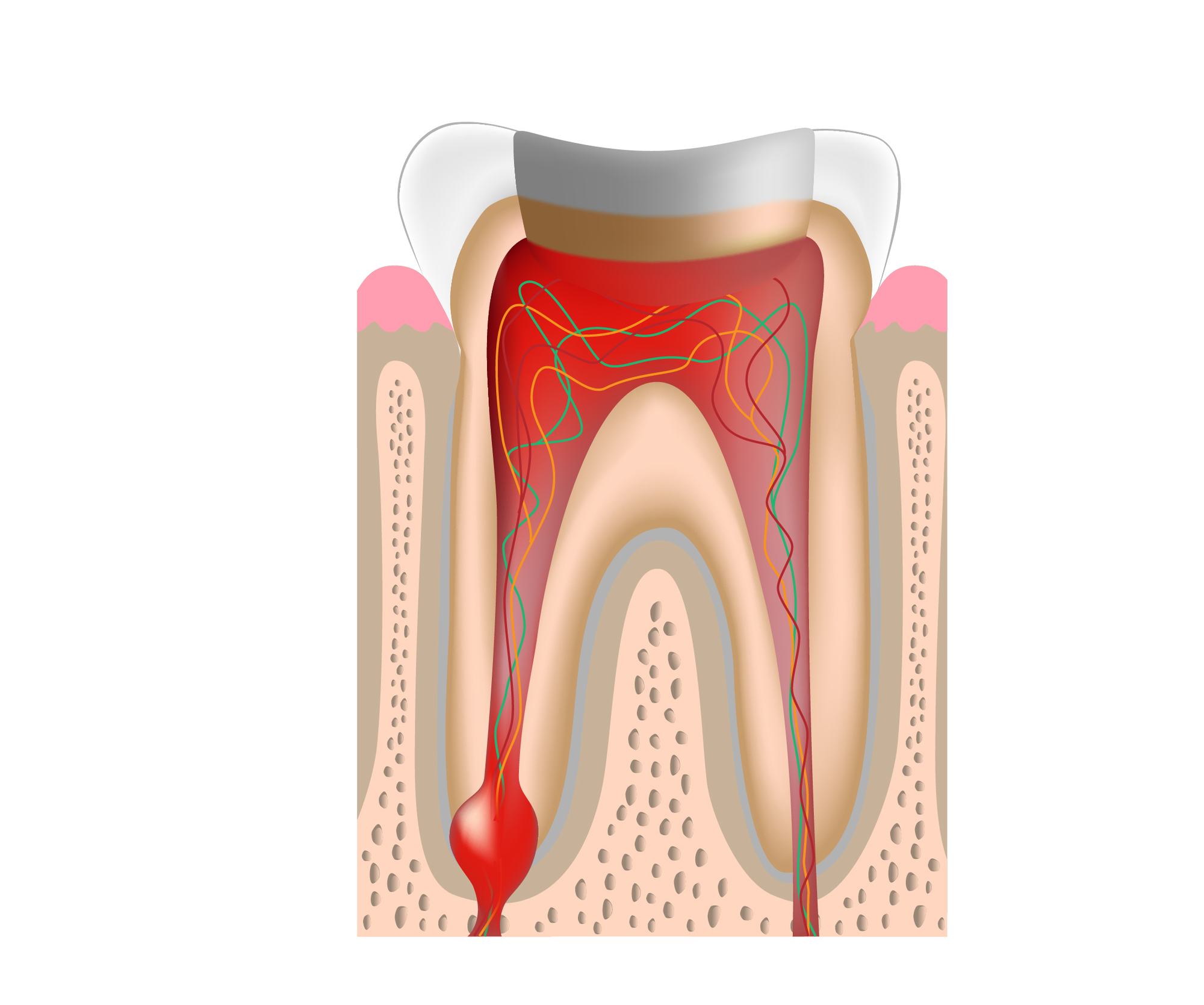 虫歯、歯髄部分の除去